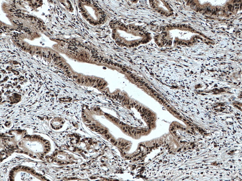 Immunohistochemistry (IHC) staining of human pancreas cancer tissue using ELF1 Polyclonal antibody (22565-1-AP)