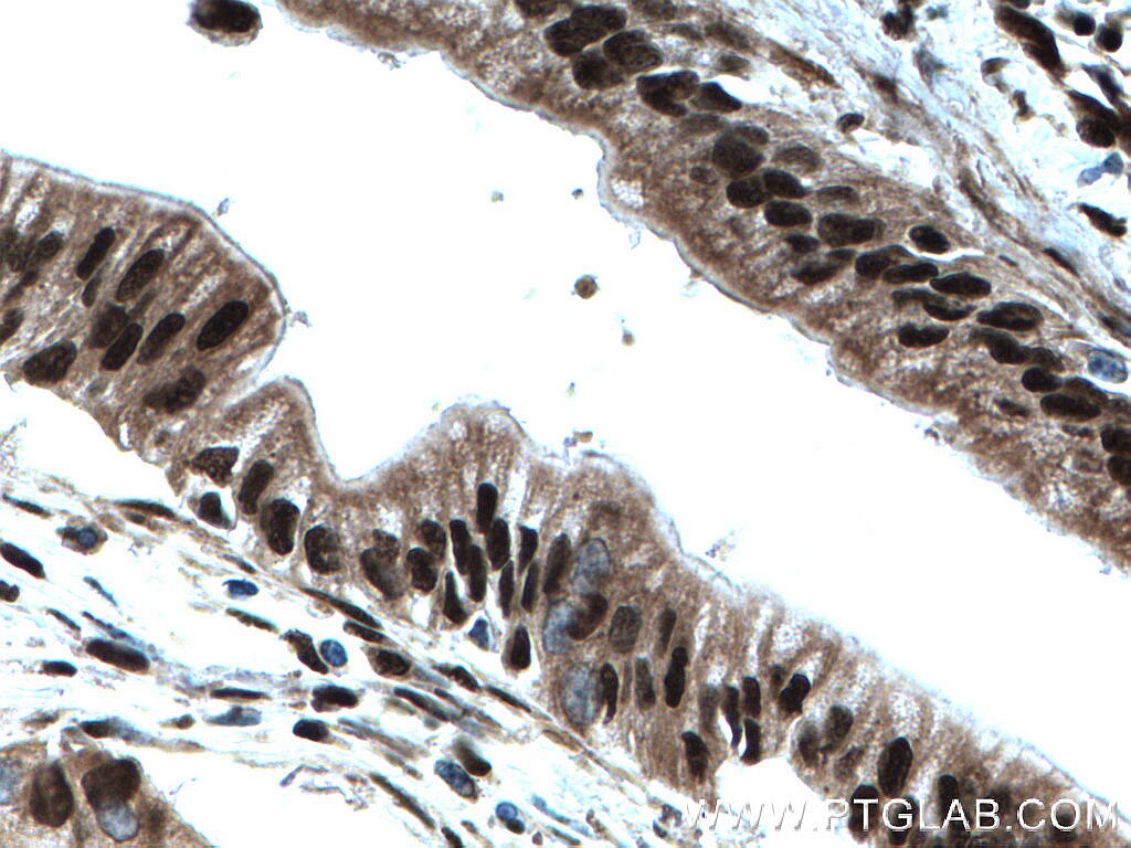 Immunohistochemistry (IHC) staining of human pancreas cancer tissue using ELF1 Polyclonal antibody (22565-1-AP)