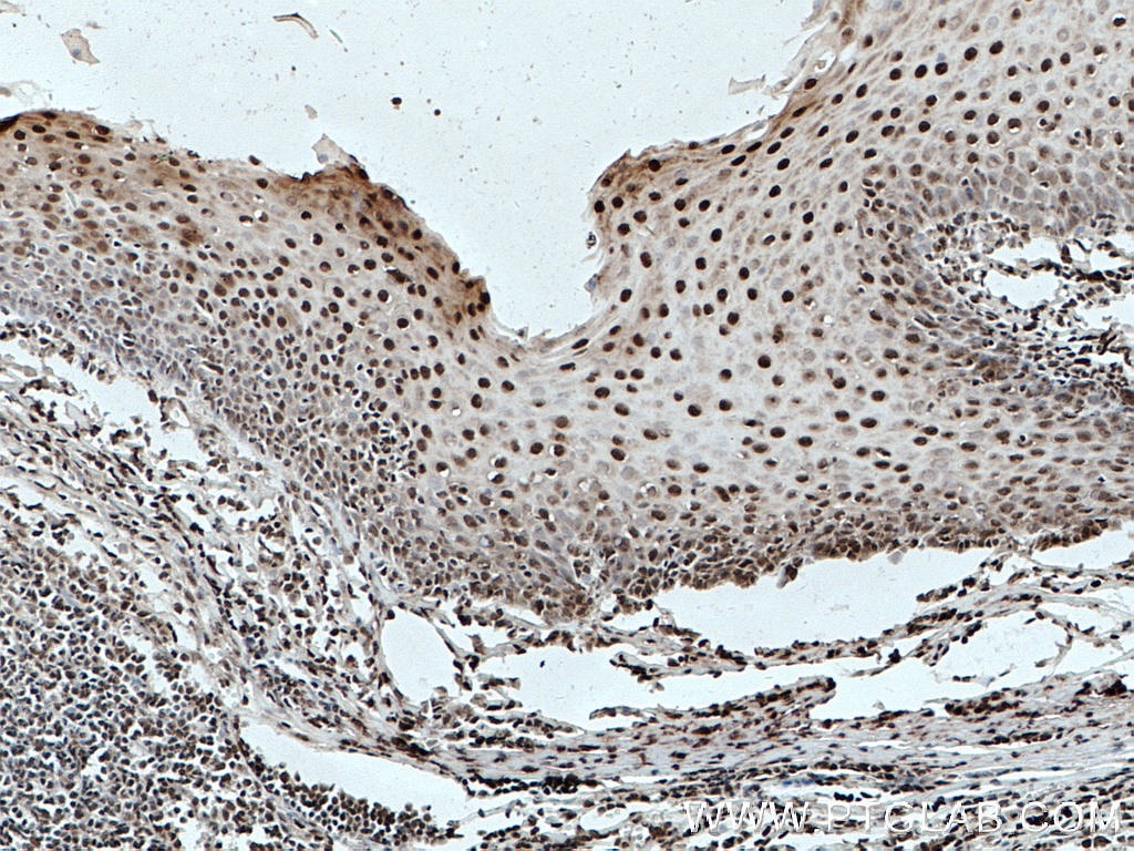 Immunohistochemistry (IHC) staining of human tonsillitis tissue using ELF1 Polyclonal antibody (22565-1-AP)