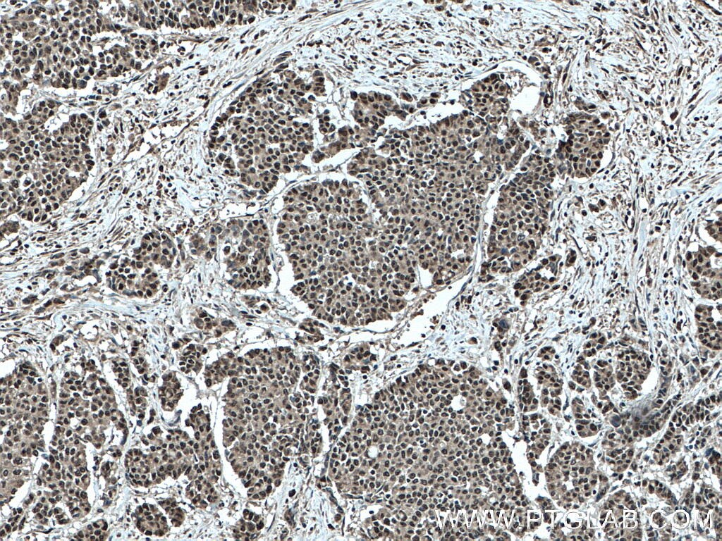 IHC staining of human colon cancer using 22565-1-AP