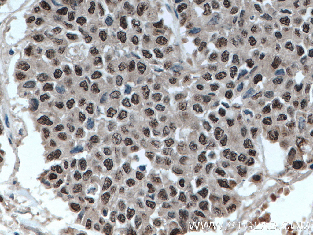 Immunohistochemistry (IHC) staining of human colon cancer tissue using ELF1 Polyclonal antibody (22565-1-AP)