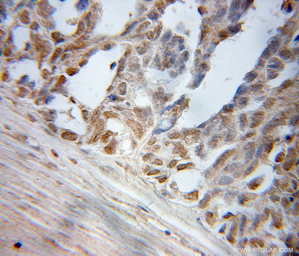 Immunohistochemistry (IHC) staining of human ovary tumor tissue using ELL Polyclonal antibody (51044-1-AP)