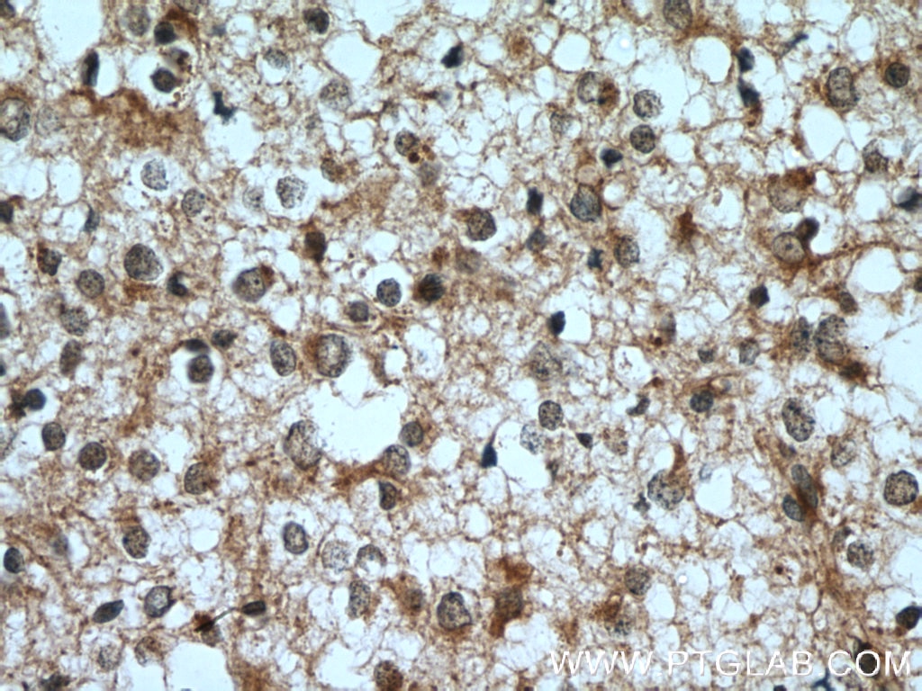 Immunohistochemistry (IHC) staining of human gliomas tissue using ELMOD1 Polyclonal antibody (12761-1-AP)
