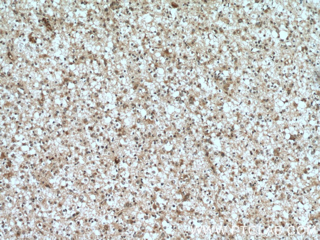Immunohistochemistry (IHC) staining of human gliomas tissue using ELMOD1 Polyclonal antibody (12761-1-AP)