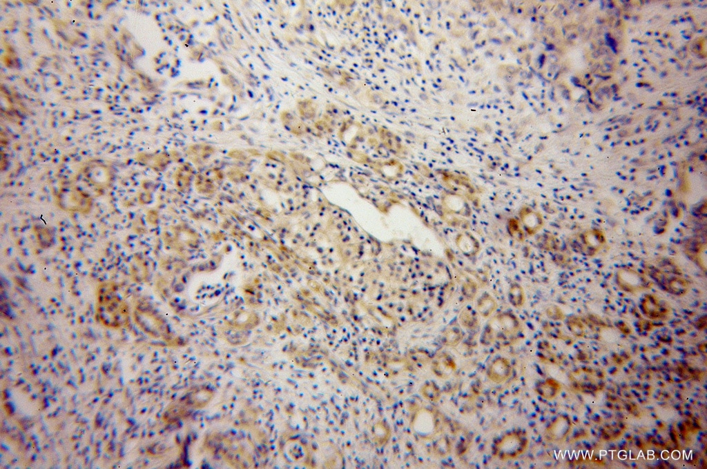 Immunohistochemistry (IHC) staining of human pancreas cancer tissue using ELMOD2 Polyclonal antibody (13027-1-AP)