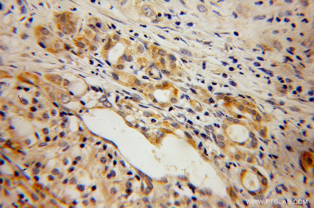 Immunohistochemistry (IHC) staining of human pancreas cancer tissue using ELMOD2 Polyclonal antibody (13027-1-AP)