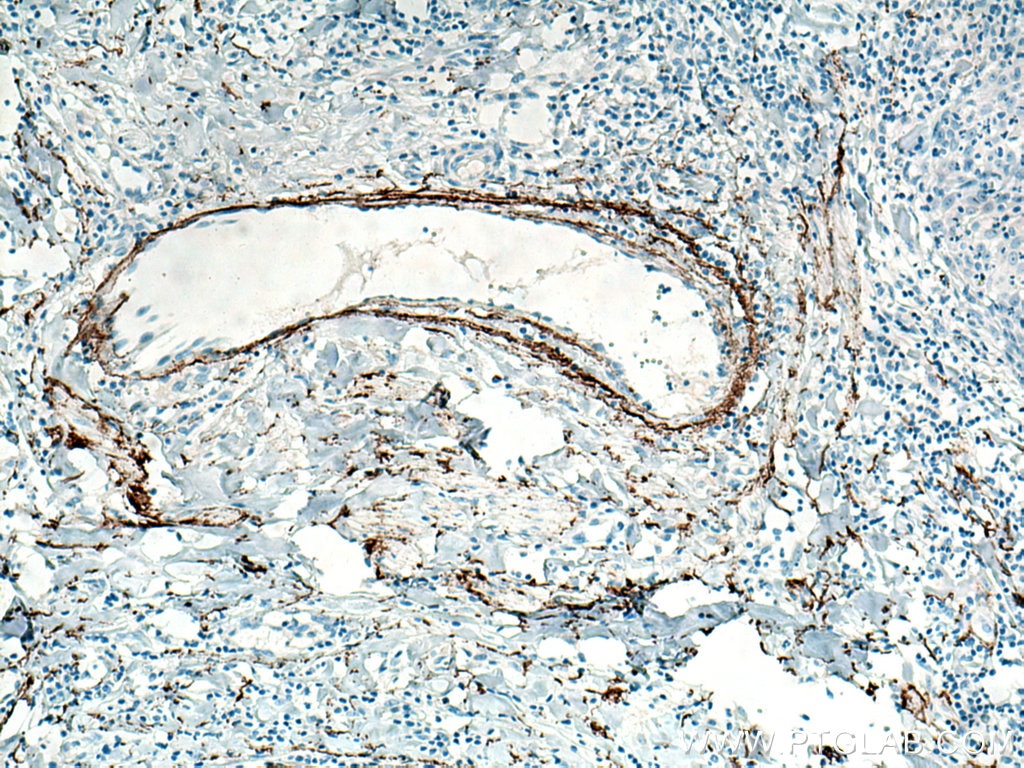 IHC staining of human skin cancer using 15257-1-AP