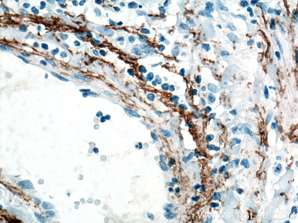 Immunohistochemistry (IHC) staining of human skin cancer tissue using Elastin Polyclonal antibody (15257-1-AP)