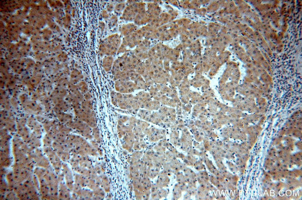 Immunohistochemistry (IHC) staining of human hepatocirrhosis tissue using ELOVL2 Polyclonal antibody (20308-1-AP)