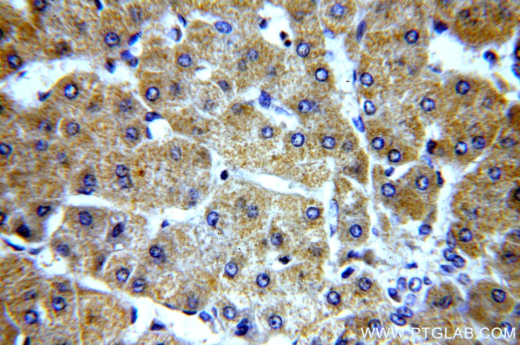 Immunohistochemistry (IHC) staining of human hepatocirrhosis tissue using ELOVL2 Polyclonal antibody (20308-1-AP)