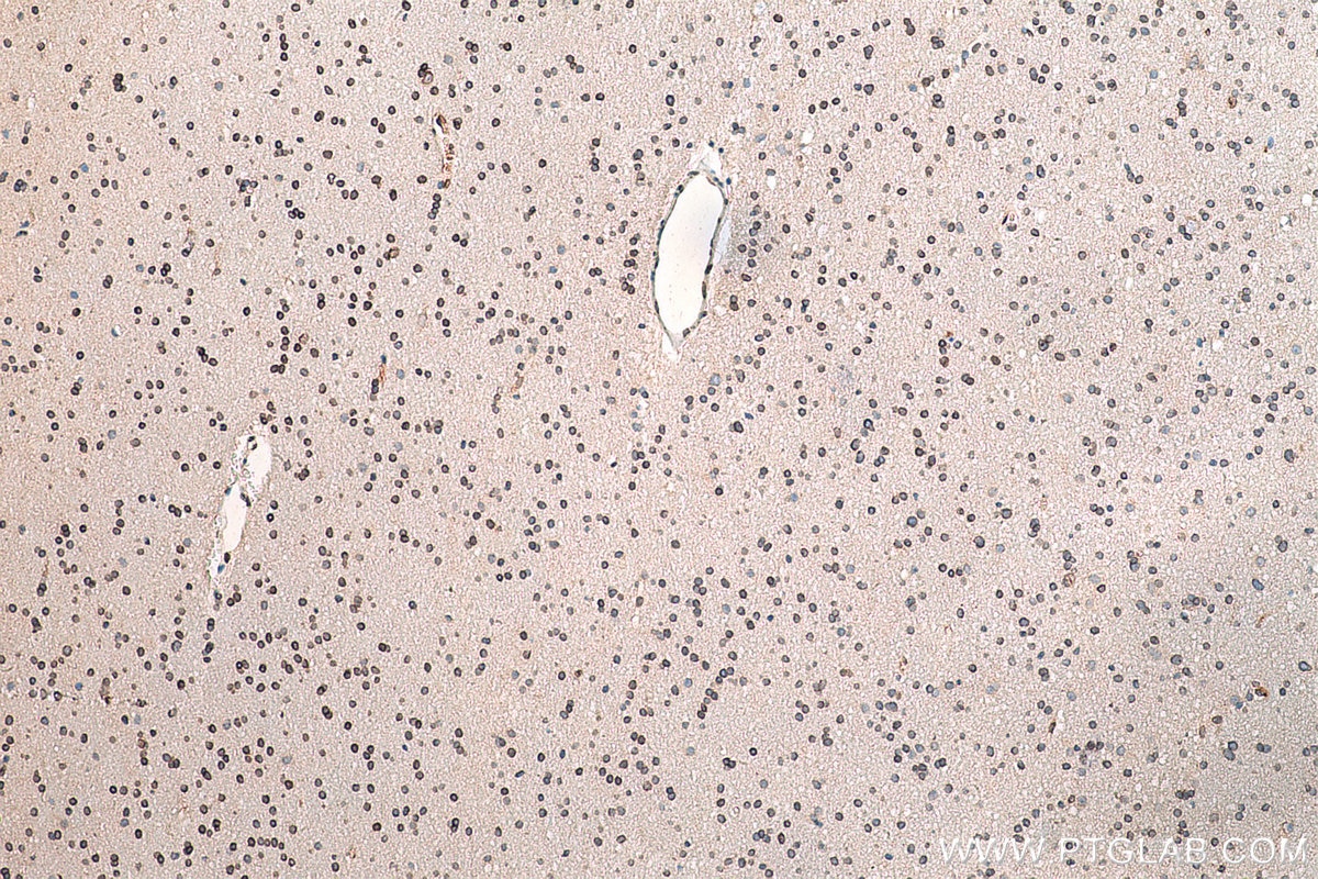 IHC staining of human gliomas using 55023-1-AP