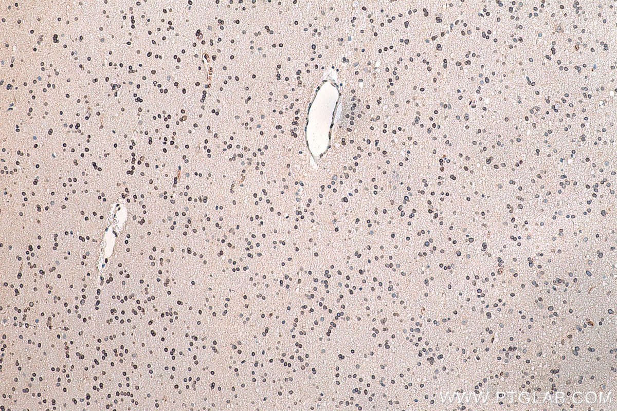 Immunohistochemistry (IHC) staining of human gliomas tissue using ELOVL4 Polyclonal antibody (55023-1-AP)