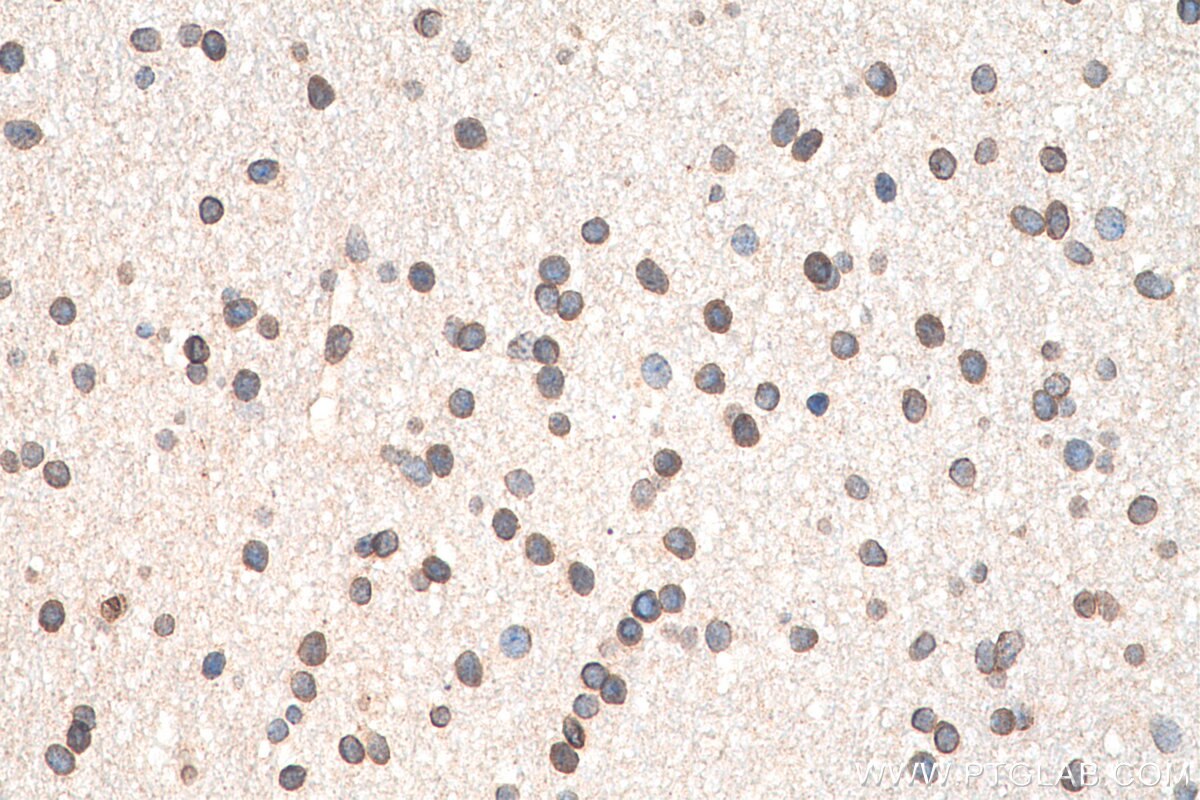Immunohistochemistry (IHC) staining of human gliomas tissue using ELOVL4 Polyclonal antibody (55023-1-AP)