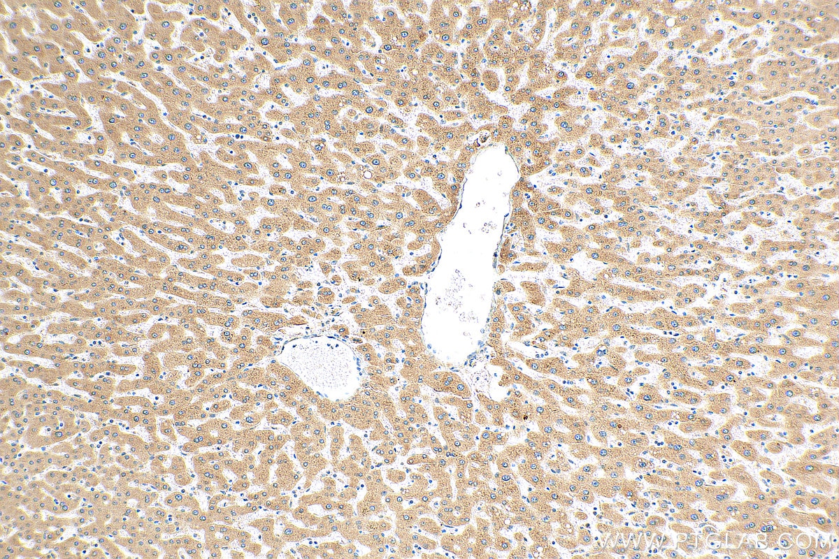 Immunohistochemistry (IHC) staining of human hepatocirrhosis tissue using ELOVL6 Polyclonal antibody (21160-1-AP)
