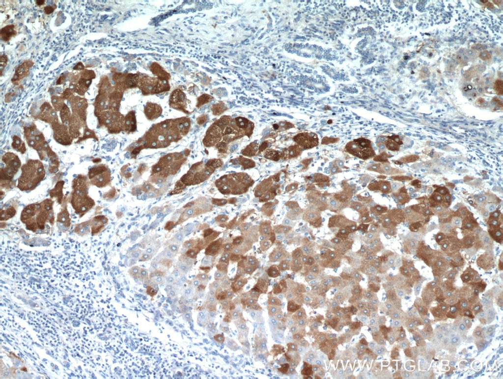 Immunohistochemistry (IHC) staining of human hepatocirrhosis tissue using ELOVL6 Polyclonal antibody (21160-1-AP)