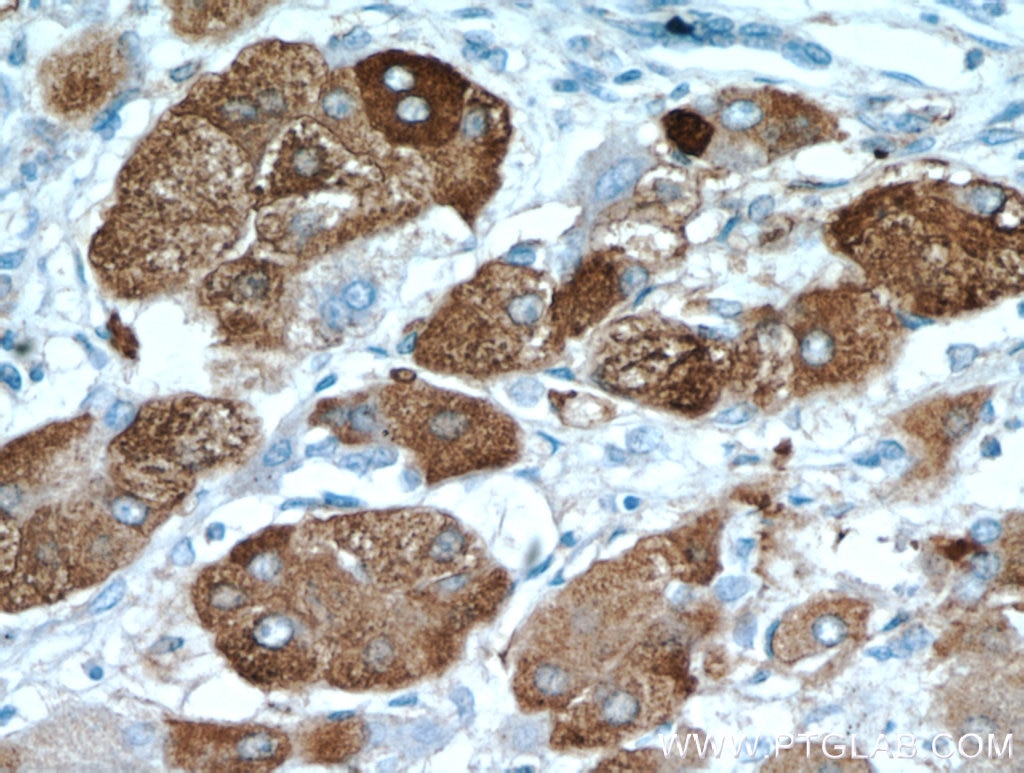 Immunohistochemistry (IHC) staining of human hepatocirrhosis tissue using ELOVL6 Polyclonal antibody (21160-1-AP)