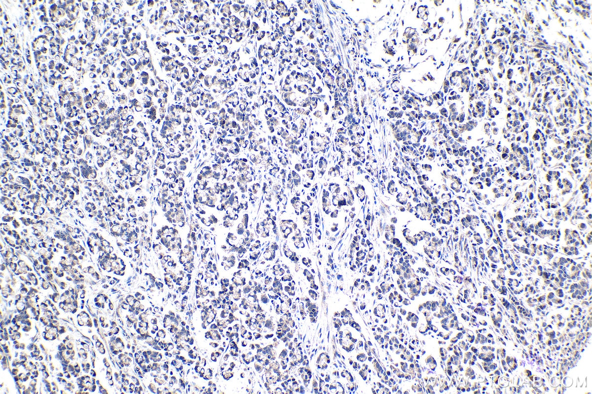 Immunohistochemistry (IHC) staining of human colon cancer tissue using ELP2 Polyclonal antibody (13793-1-AP)