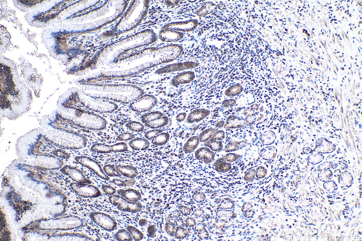 Immunohistochemistry (IHC) staining of human stomach cancer tissue using ELP2 Polyclonal antibody (13793-1-AP)