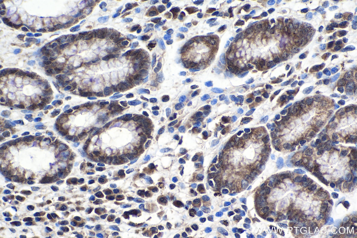 Immunohistochemistry (IHC) staining of human stomach cancer tissue using ELP2 Polyclonal antibody (13793-1-AP)