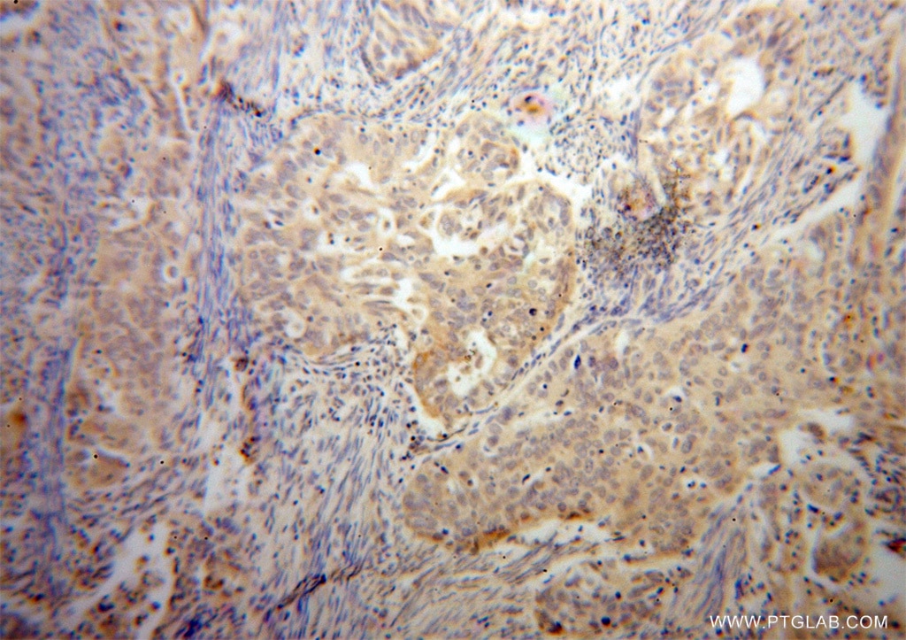 Immunohistochemistry (IHC) staining of human endometrial cancer tissue using ELP4 Polyclonal antibody (12746-1-AP)