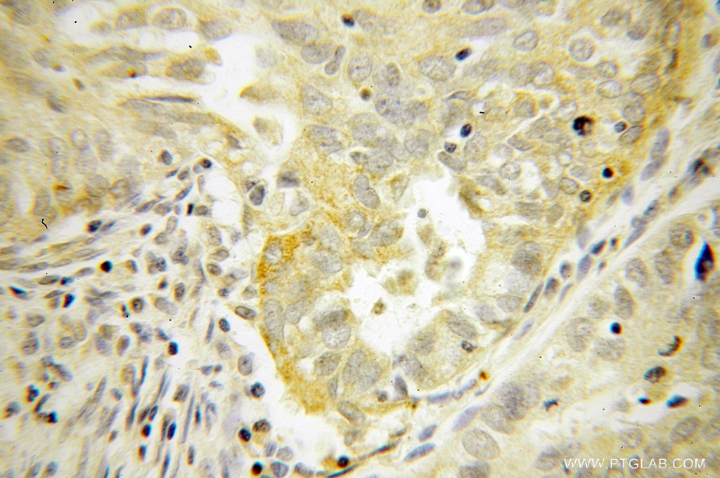 Immunohistochemistry (IHC) staining of human endometrial cancer tissue using ELP4 Polyclonal antibody (12746-1-AP)