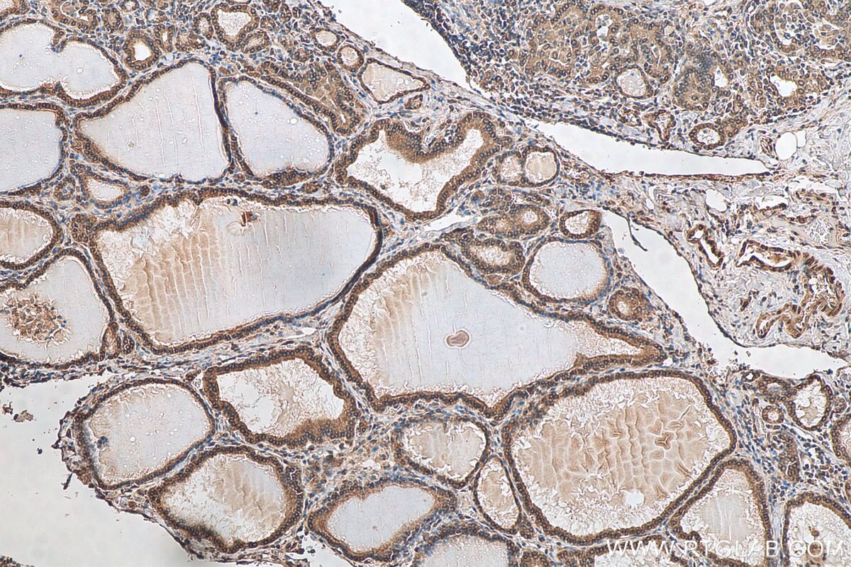 Immunohistochemistry (IHC) staining of human thyroid cancer tissue using Emerin Polyclonal antibody (10351-1-AP)