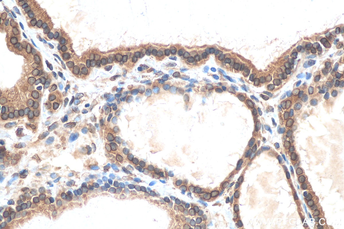 Immunohistochemistry (IHC) staining of human thyroid cancer tissue using Emerin Polyclonal antibody (10351-1-AP)