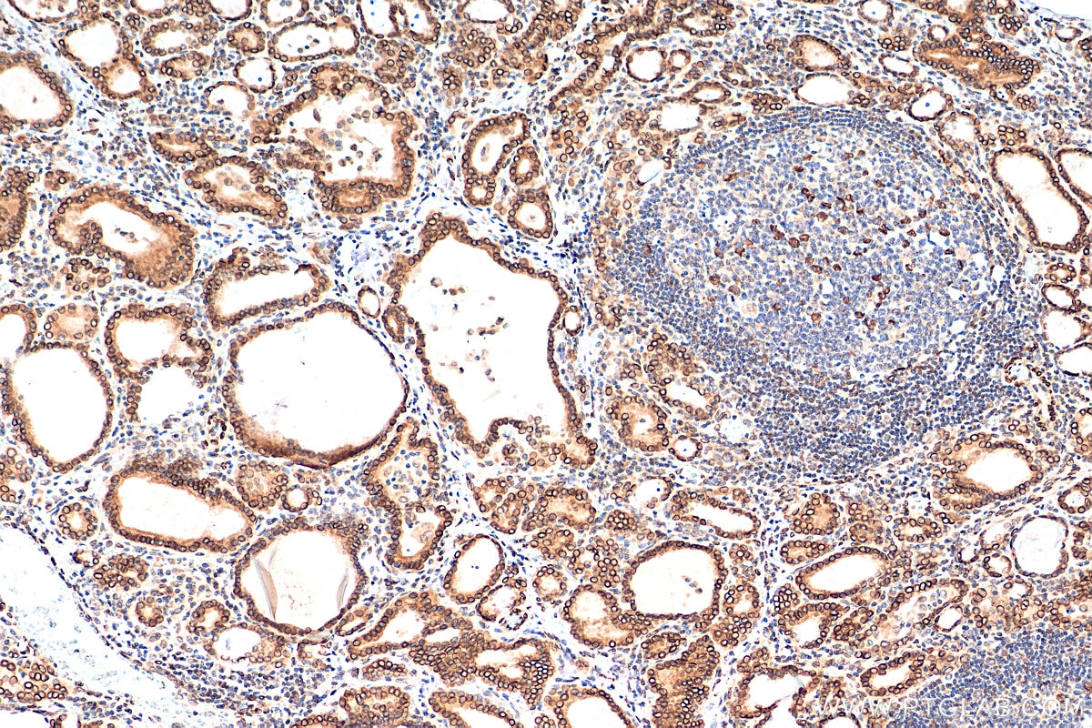 Immunohistochemistry (IHC) staining of human thyroid cancer tissue using Emerin Polyclonal antibody (10351-1-AP)