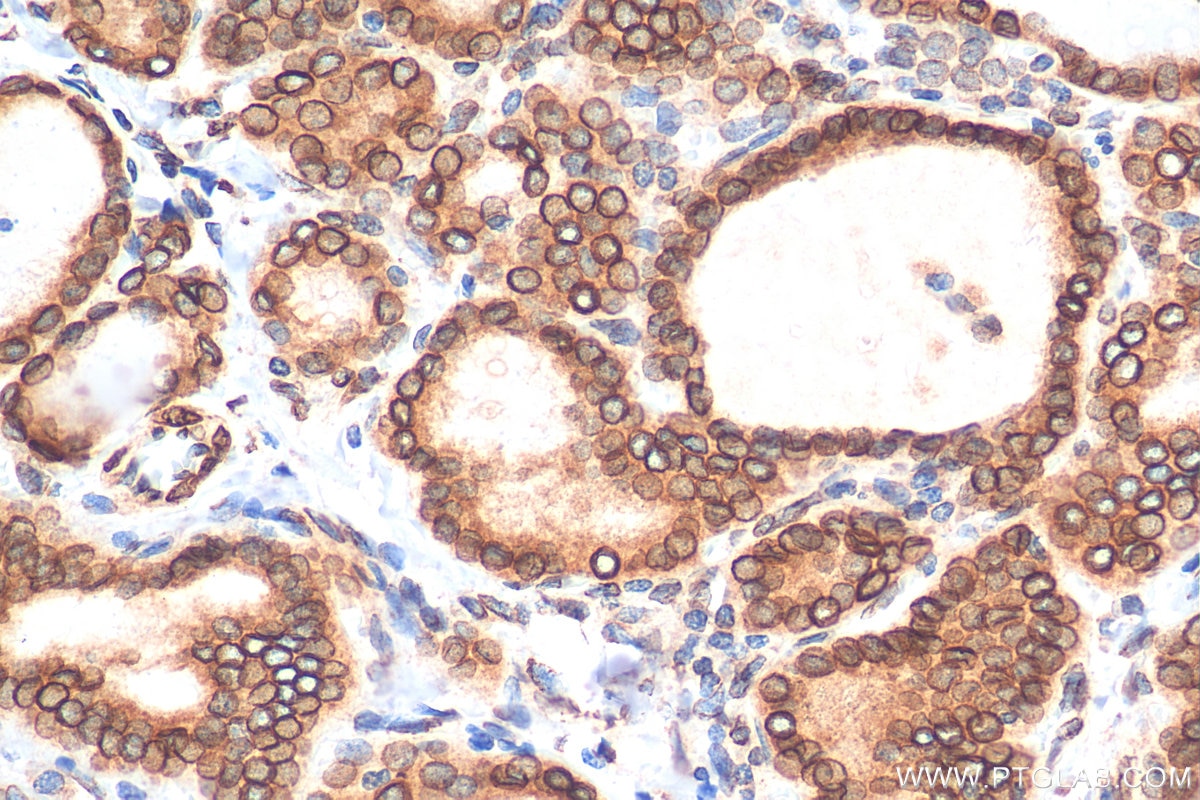 Immunohistochemistry (IHC) staining of human thyroid cancer tissue using Emerin Polyclonal antibody (10351-1-AP)