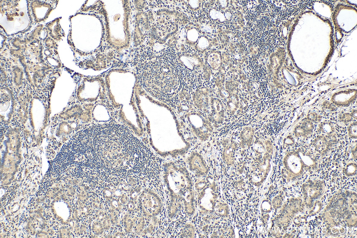 Immunohistochemistry (IHC) staining of human thyroid cancer tissue using EMD Recombinant antibody (82888-2-RR)