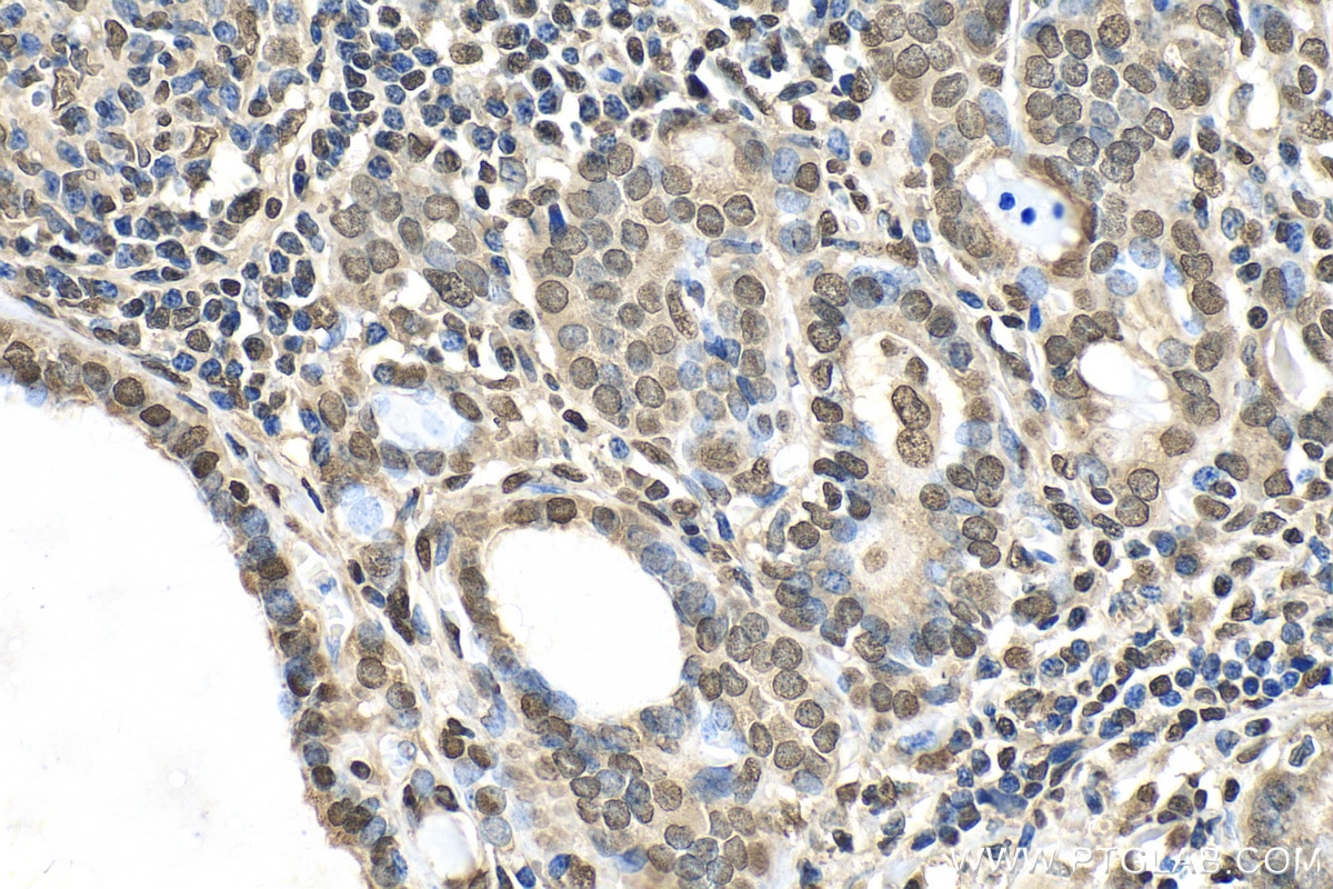 Immunohistochemistry (IHC) staining of human thyroid cancer tissue using EMD Recombinant antibody (82888-2-RR)