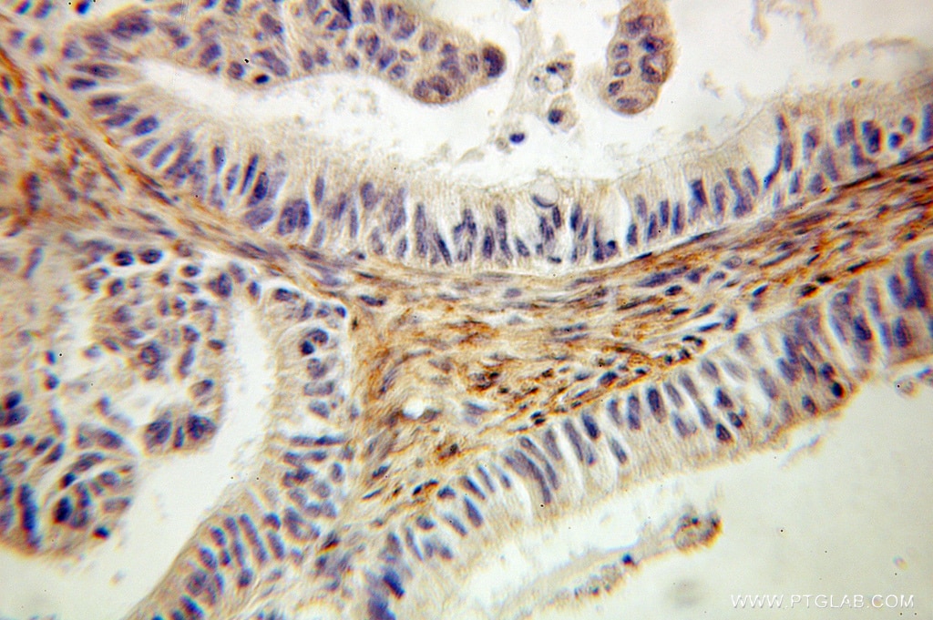 Immunohistochemistry (IHC) staining of human ovary tumor tissue using EMILIN1 Polyclonal antibody (10643-1-AP)