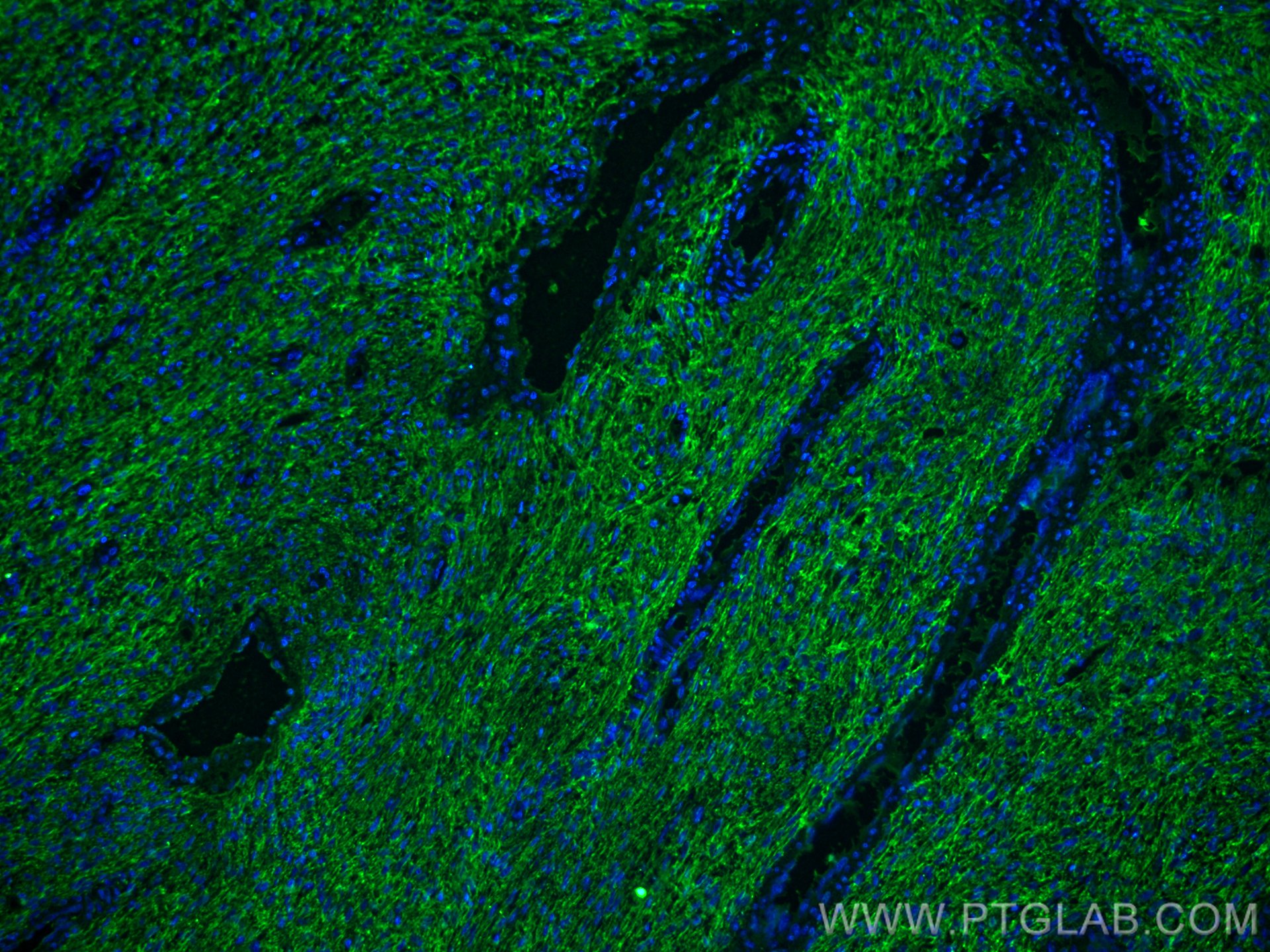 Immunofluorescence (IF) / fluorescent staining of human ovary tumor tissue using EMILIN1 Monoclonal antibody (60047-1-Ig)