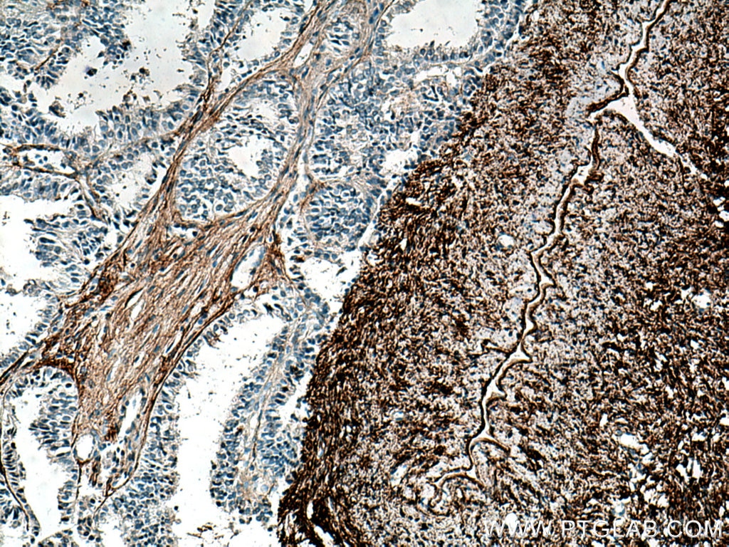 Immunohistochemistry (IHC) staining of human ovary tumor tissue using EMILIN1 Monoclonal antibody (60047-1-Ig)