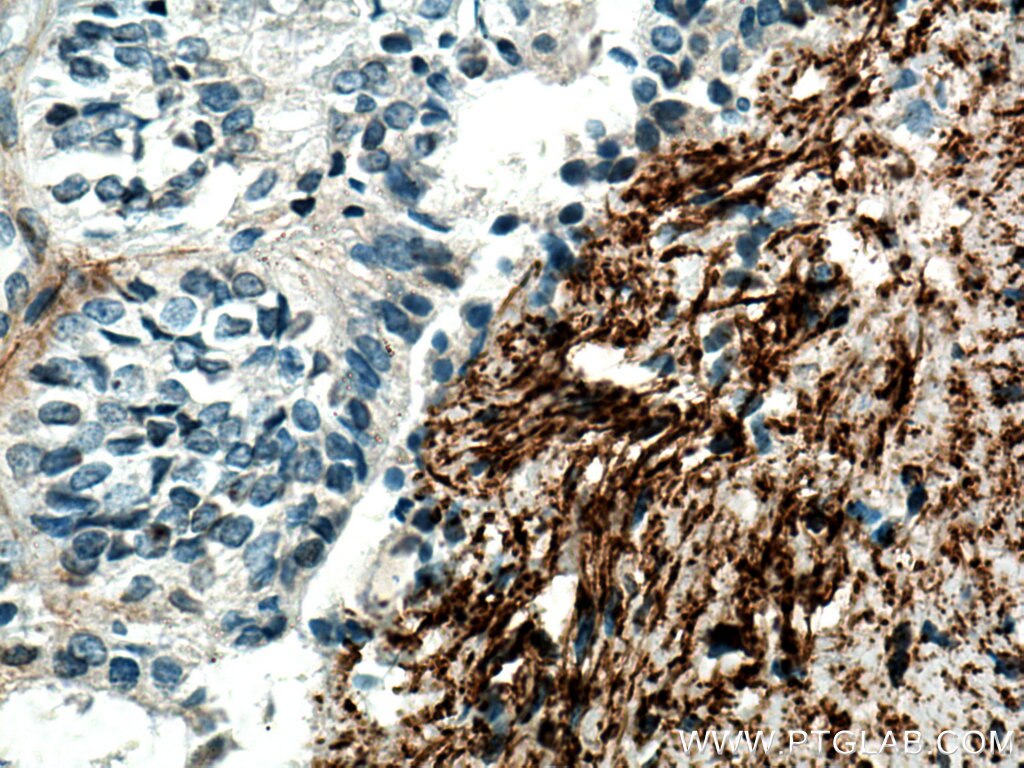 Immunohistochemistry (IHC) staining of human ovary tumor tissue using EMILIN1 Monoclonal antibody (60047-1-Ig)