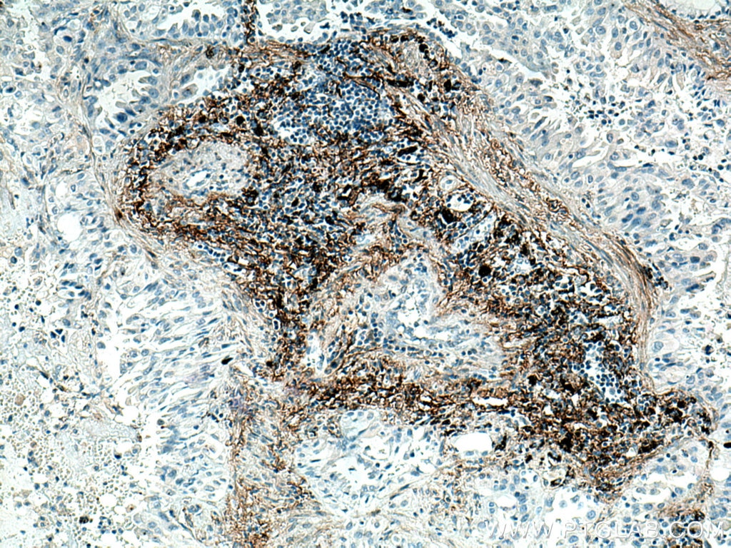 Immunohistochemistry (IHC) staining of human lung cancer tissue using EMILIN1 Monoclonal antibody (60047-1-Ig)