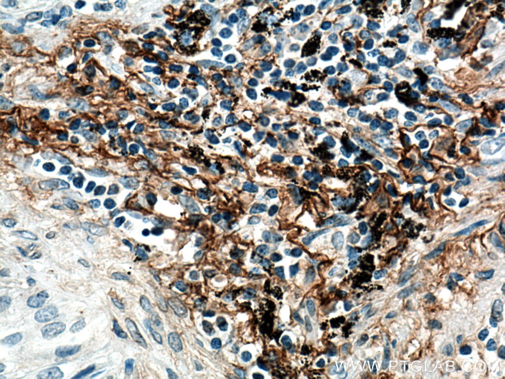 Immunohistochemistry (IHC) staining of human lung cancer tissue using EMILIN1 Monoclonal antibody (60047-1-Ig)