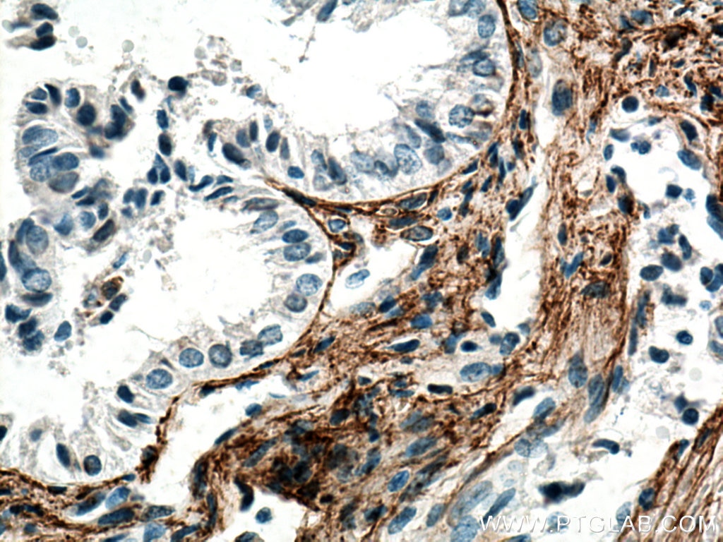 Immunohistochemistry (IHC) staining of human ovary tumor tissue using EMILIN1 Monoclonal antibody (60047-1-Ig)