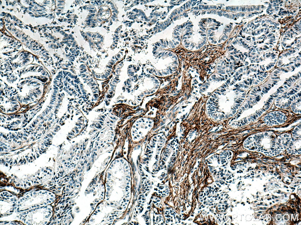 Immunohistochemistry (IHC) staining of human ovary tumor tissue using EMILIN1 Monoclonal antibody (60047-1-Ig)