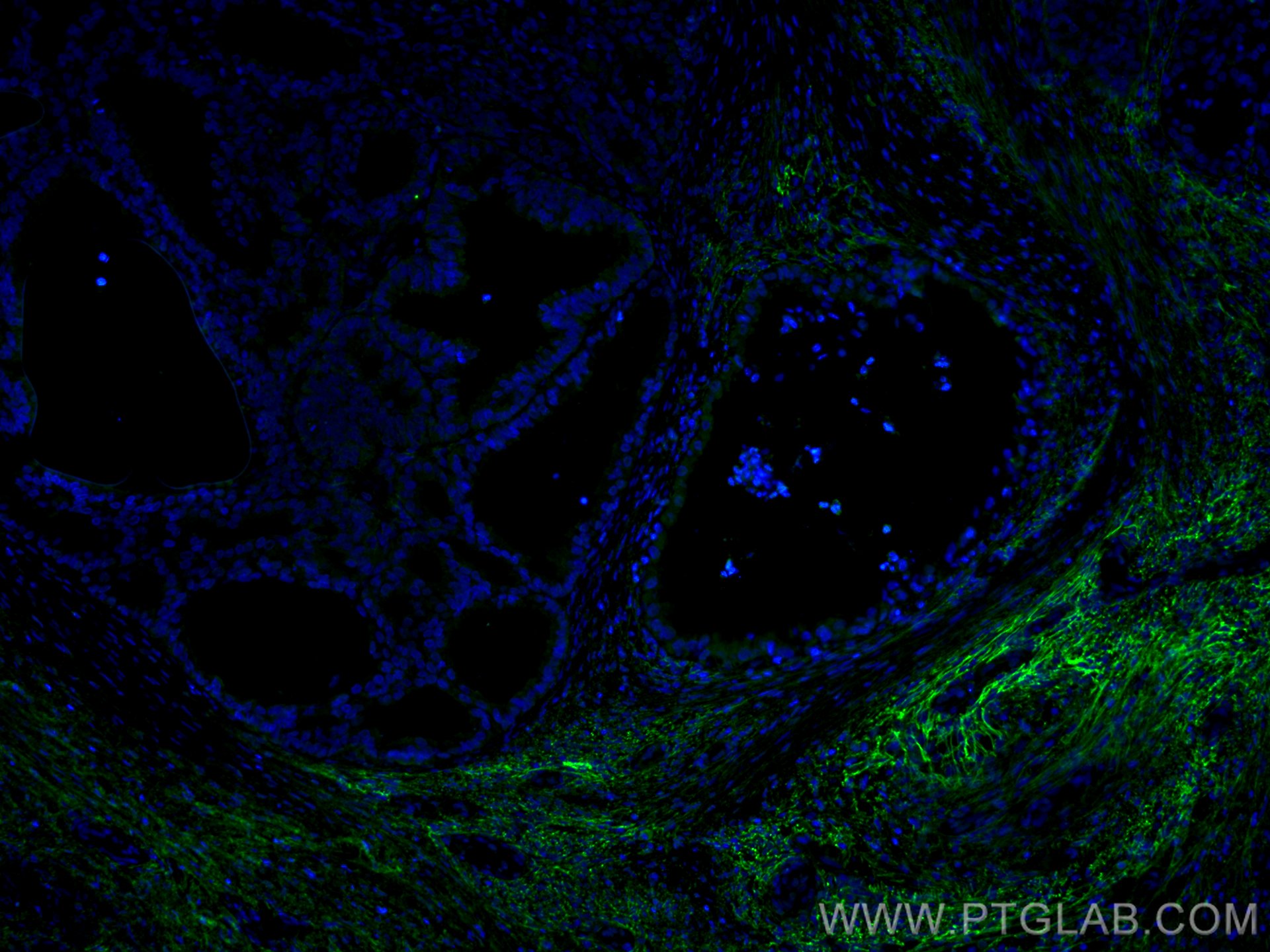 Immunofluorescence (IF) / fluorescent staining of human ovary tumor tissue using CoraLite® Plus 488-conjugated EMILIN1 Monoclonal a (CL488-60047)