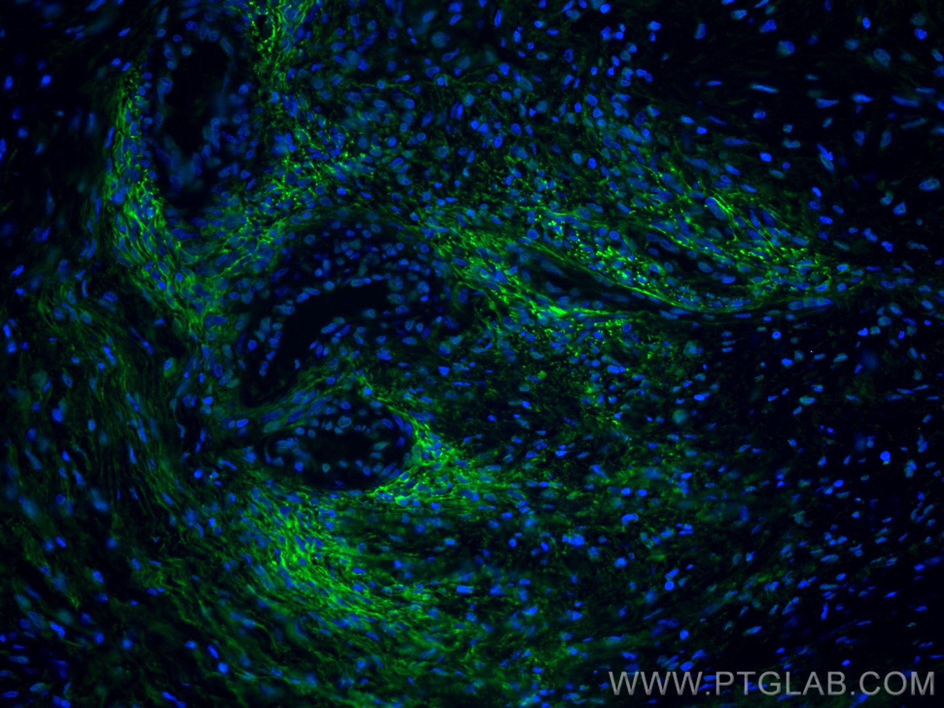 IF Staining of human ovary tumor using CL488-60047