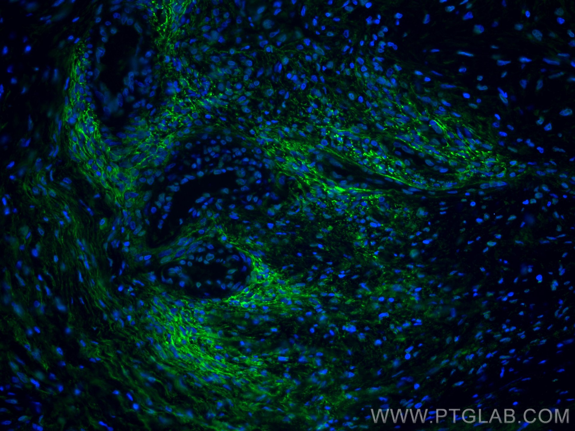 Immunofluorescence (IF) / fluorescent staining of human ovary tumor tissue using CoraLite® Plus 488-conjugated EMILIN1 Monoclonal a (CL488-60047)