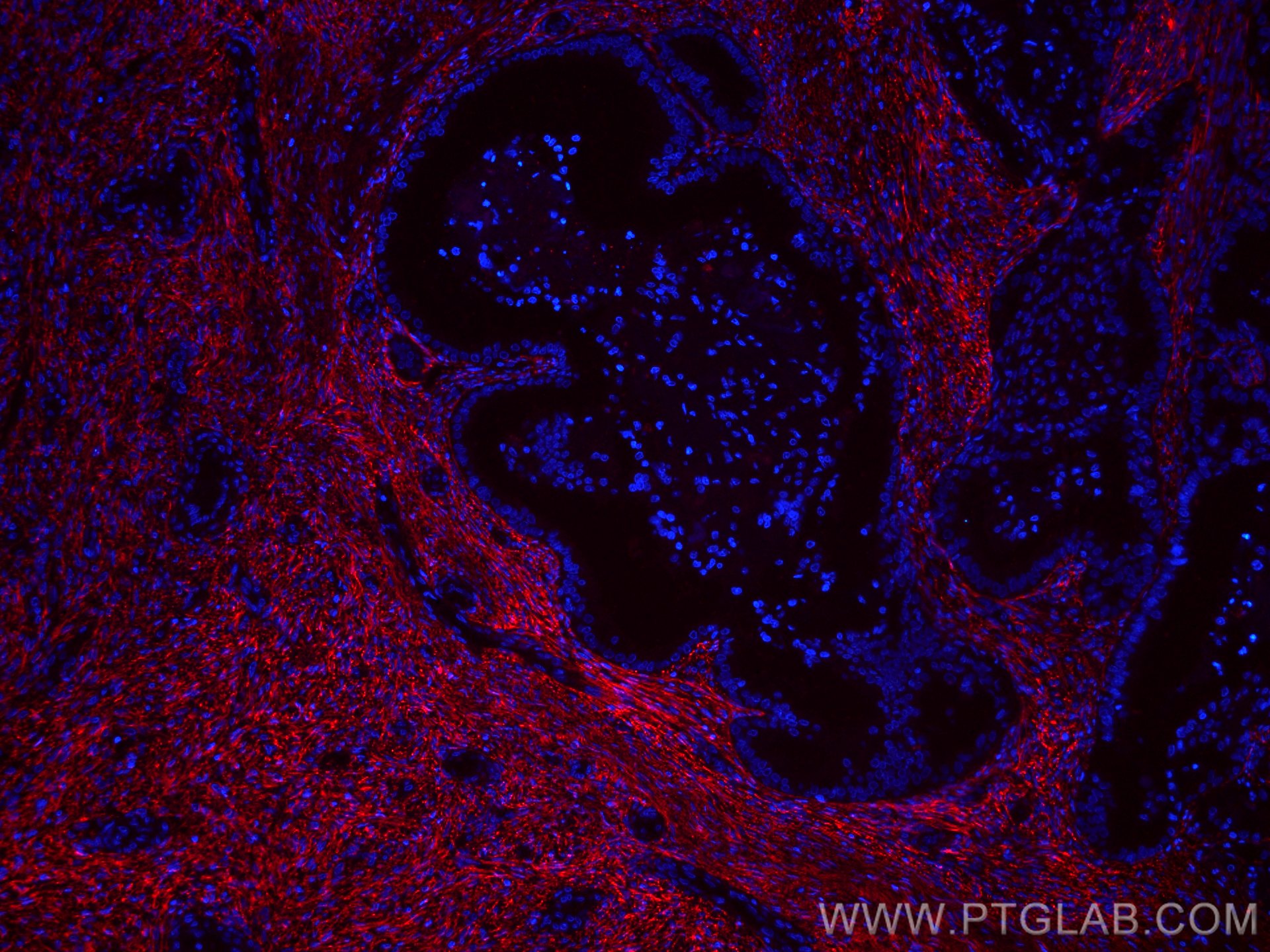 Immunofluorescence (IF) / fluorescent staining of human ovary tumor tissue using CoraLite®594-conjugated EMILIN1 Monoclonal antibod (CL594-60047)