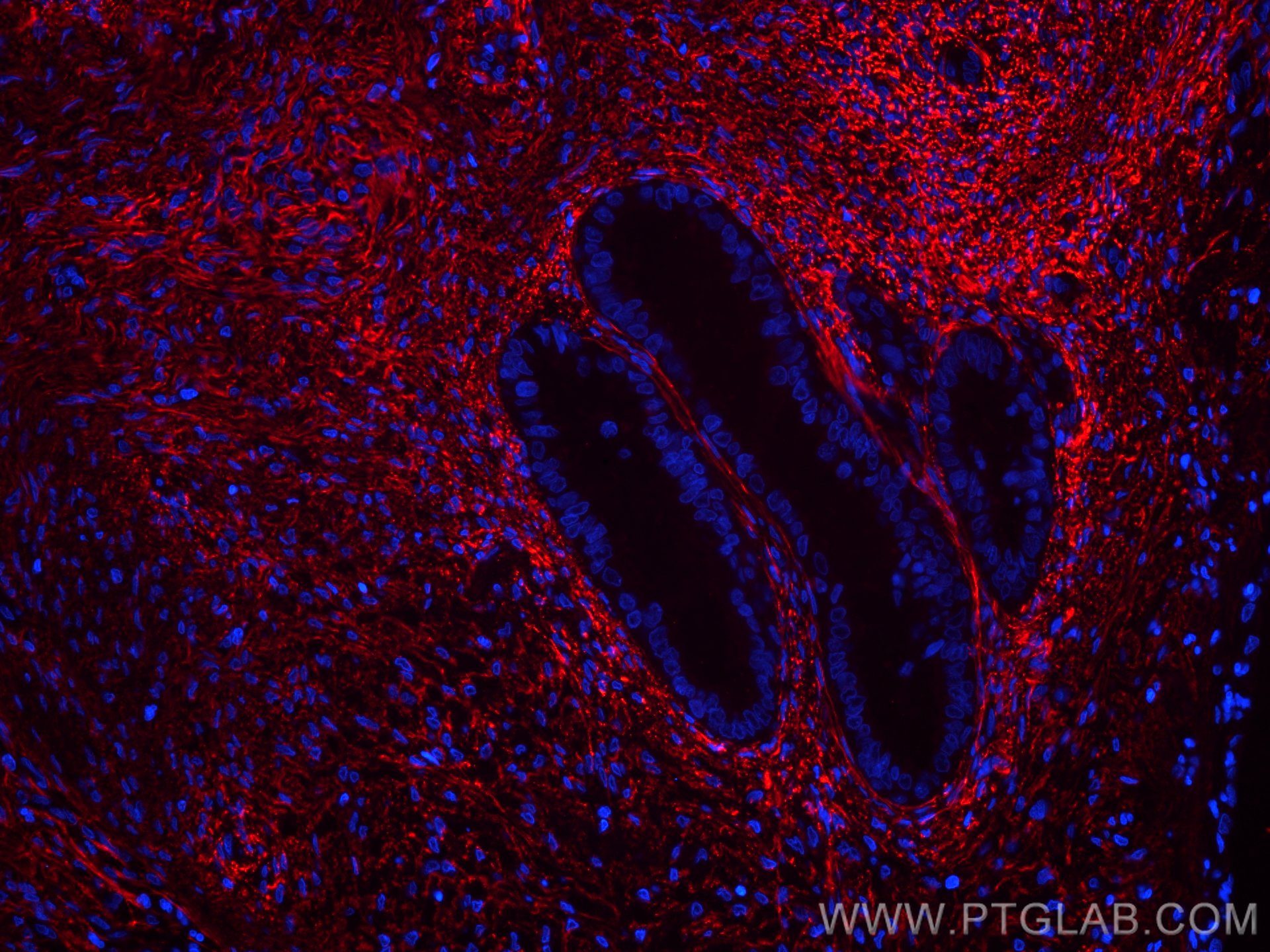 IF Staining of human ovary tumor using CL594-60047