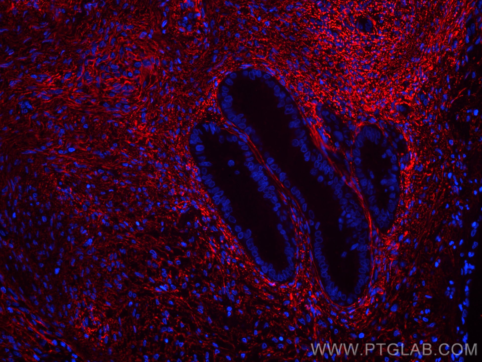 Immunofluorescence (IF) / fluorescent staining of human ovary tumor tissue using CoraLite®594-conjugated EMILIN1 Monoclonal antibod (CL594-60047)