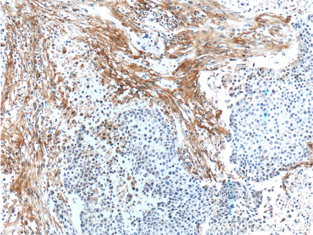 Immunohistochemistry (IHC) staining of human lung cancer tissue using EMILIN2 Polyclonal antibody (24779-1-AP)