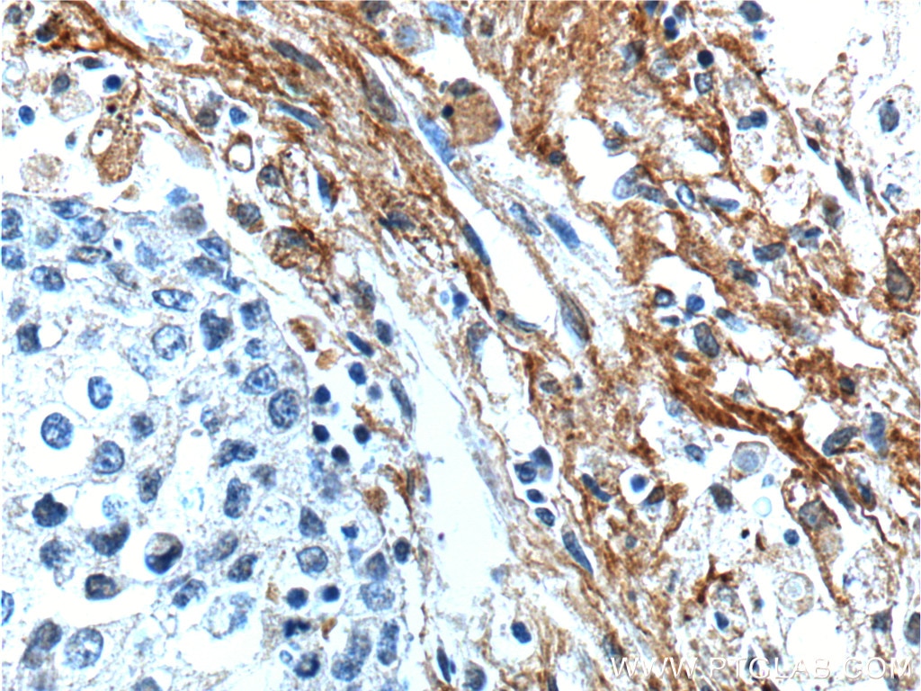 Immunohistochemistry (IHC) staining of human lung cancer tissue using EMILIN2 Polyclonal antibody (24779-1-AP)
