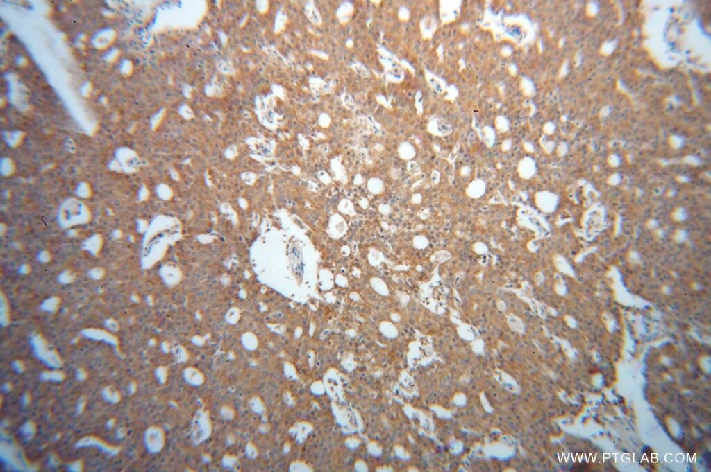 Immunohistochemistry (IHC) staining of human prostate cancer tissue using EML2 Polyclonal antibody (13529-1-AP)