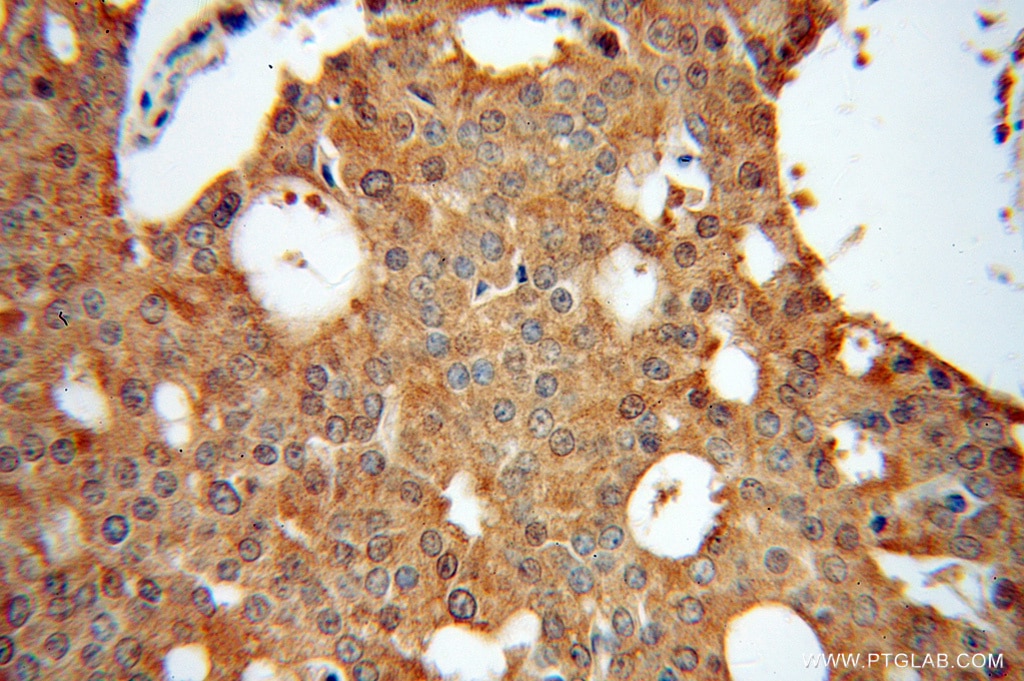 Immunohistochemistry (IHC) staining of human prostate cancer tissue using EML2 Polyclonal antibody (13529-1-AP)