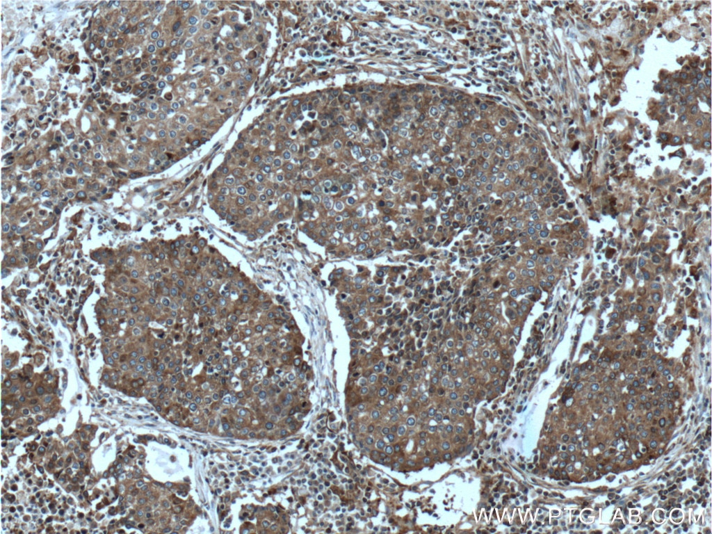Immunohistochemistry (IHC) staining of human lung cancer tissue using EML4 Polyclonal antibody (22709-1-AP)